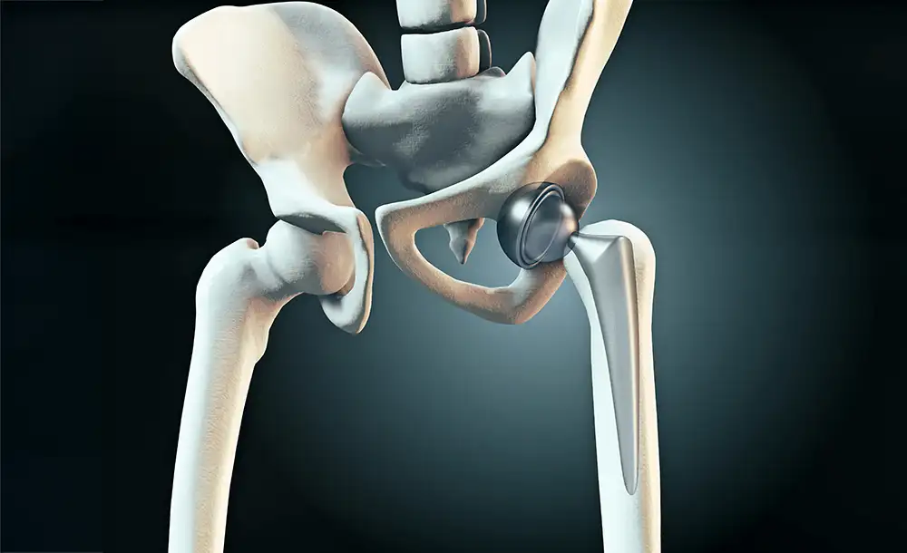 Beispiel einer medizinischen Anwendung mit orthopädischem Implantat in der Medizintechnik